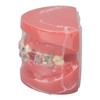 Demonstration Orthodontics Dental Model Disassembled Resin Teeth Model for Teaching