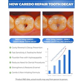 CAREDO- “Dentífrico Tratamiento Caries para Adultos, Inicio Reparación de Cavidades Pasta de Dientes Cura Reparación de Dientes Ca