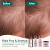 Nature Spell Dandruff Complex Hair Oil, Pre-Diluted Scalp Oil, Helps