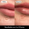 Lusabe Parches Para Acn Invisibles 36pzs Pimple Patch