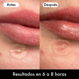 Lusabe Parches Para Acn Invisibles 36pzs Pimple Patch                                                                                                 