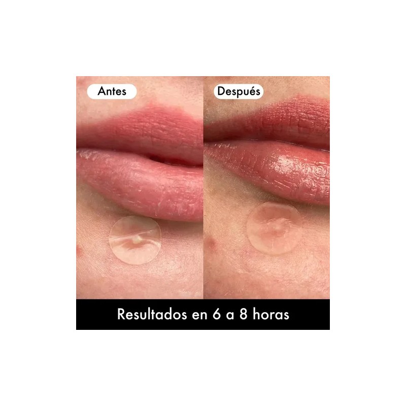 Lusabe Parches Para Acn Invisibles 36pzs Pimple Patch