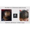 Solución Anticaida Para Hombre Con Cabello Con Caspa