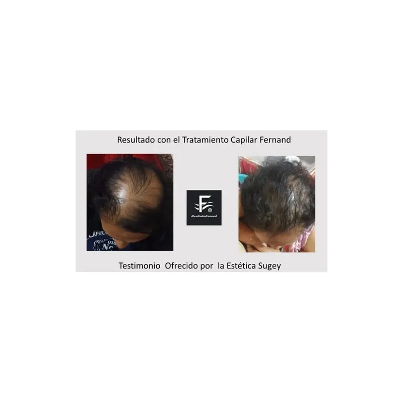 Solución Anticaida Para Hombre Con Cabello Con Caspa