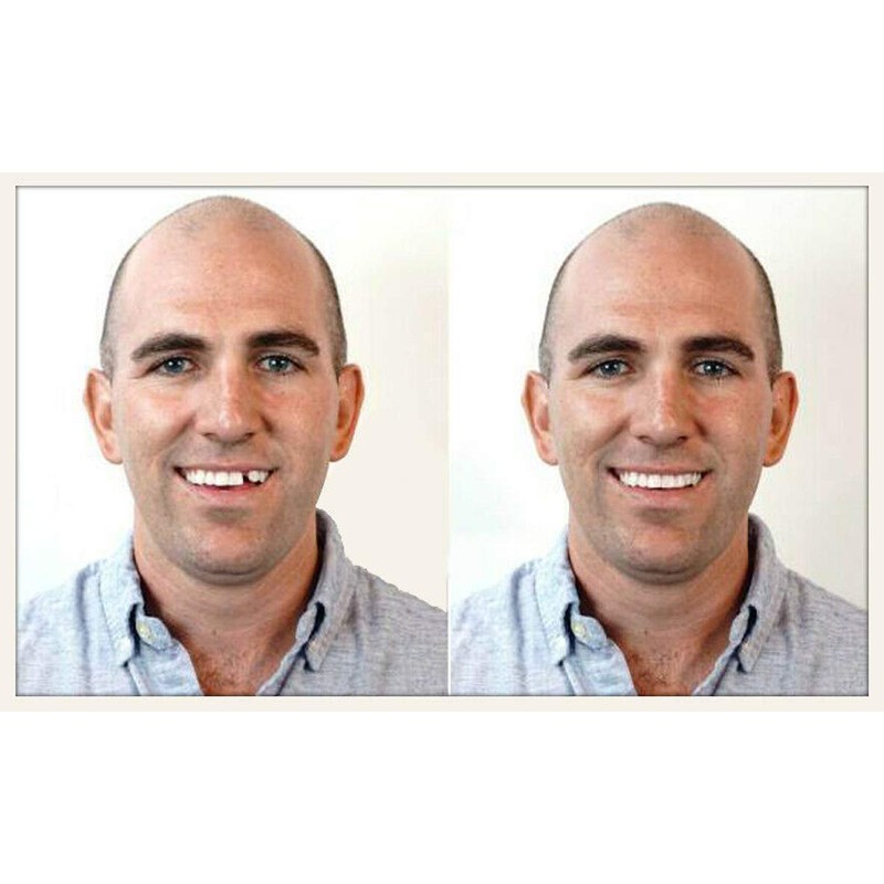 Instant Smile Select A Tooth Temporary Tooth Replacement Kit -