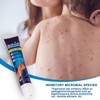 Urticaria Antipruritic Cream 20g Natural Herbal Anti Itch Ointment