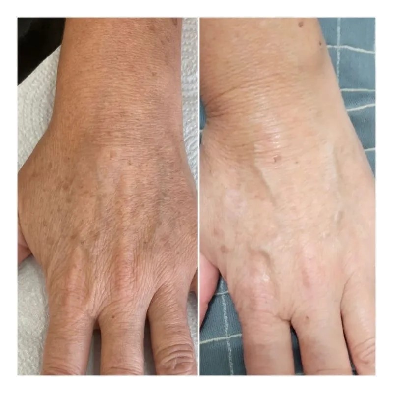 Crema De Noche Anti Acné Paño Y Manchas + Agua