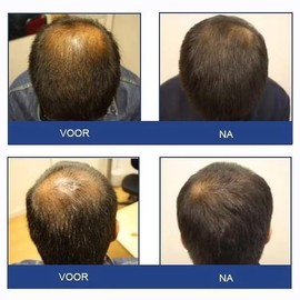 FOLIGAIN Stimulating Shampoo for Thinning Hair For Men with 2 Trioxidil (8oz) 236ml                                                                   