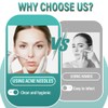 2 Acne Pimple Tweezers Blackhead Remover, Comedone Squeezer, Blackhead Remover,