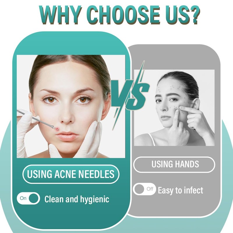 2 Acne Pimple Tweezers Blackhead Remover, Comedone Squeezer, Blackhead Remover,