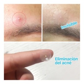 Parches Para Acne Elimina Espinillas Granos Facial Noche F                                                                                            