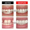 Kit Reparacion Dental Temporal Para Dientes Y Muelas Rotas