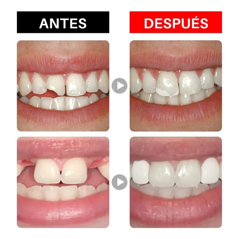 Kit Reparacion Dental Temporal Para Dientes Y Muelas Rotas