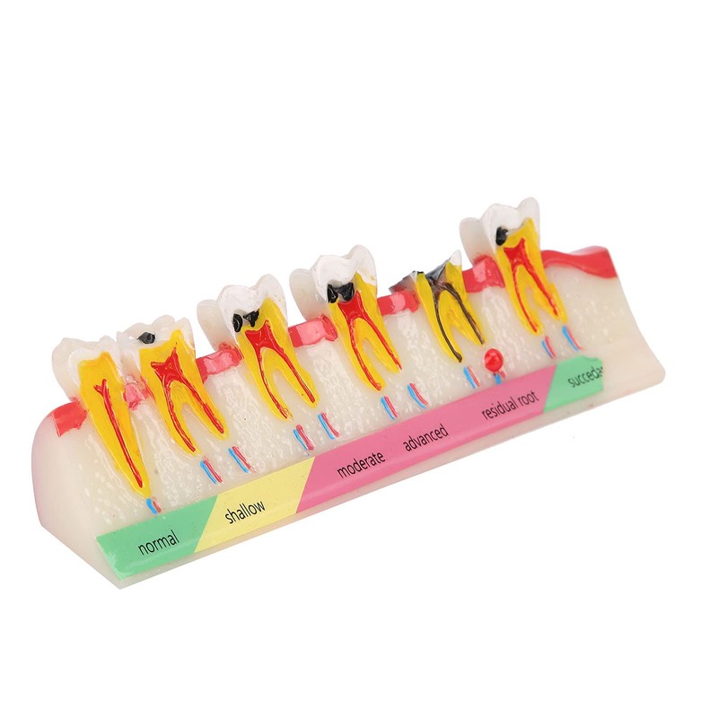 Caries Model Dental Caries Model, Model Teeth Teaching Dental Gum