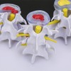 4-stage Medicals Human Lumbar Vertebrae Combination of Normal and Pathological