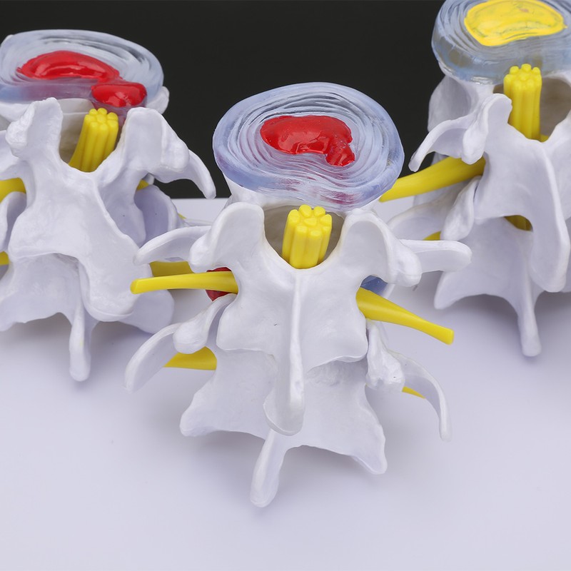 4-stage Medicals Human Lumbar Vertebrae Combination of Normal and Pathological
