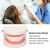 Dental Disease Caries Teeth Model Resin Simulation Teaching Prop Dental