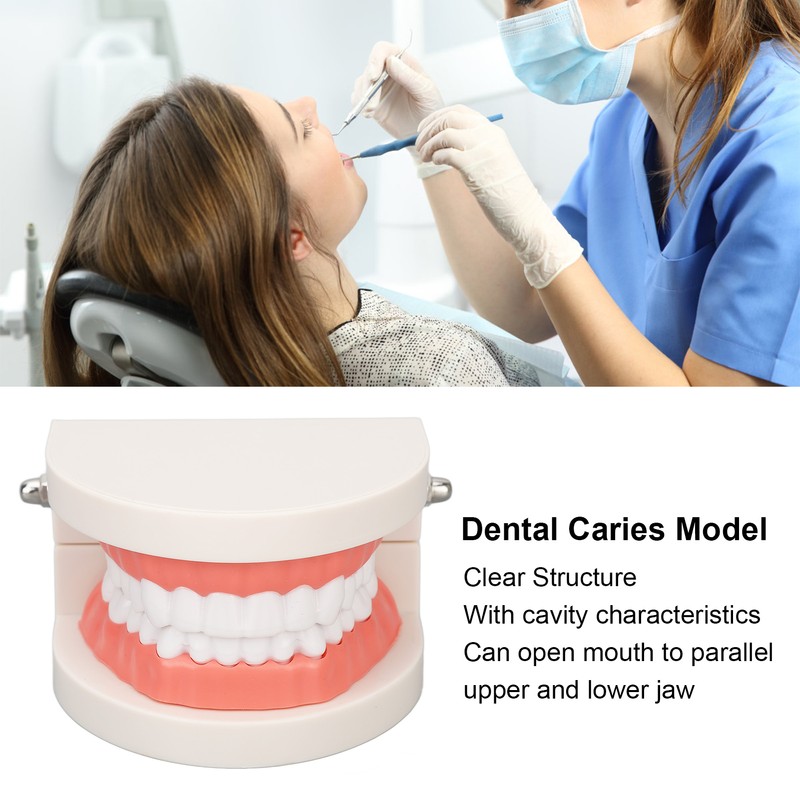 Dental Disease Caries Teeth Model Resin Simulation Teaching Prop Dental