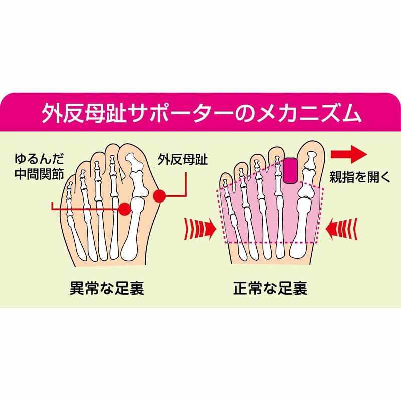 topuran Bunions Support Double 2 Piece
