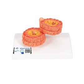 3B Scientific Human Anatomy - COPD Model + Free Anatomy App - 3B Smart Anatomy