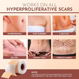 Hojas De Silicona Para Cicatrices Quirúrgicas: Cinta De Silicona Para Cicatrices Para Sección C, Cinta Abdominoplastia, Tratamiento Queloide - Tiras De Silicona Para Cicatrices Despué