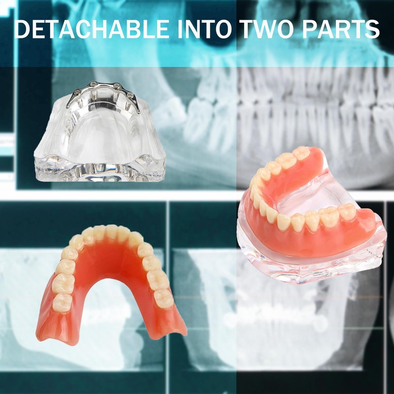 Dental Model Overdenture Transparent Dental Implants Model Detachable Model Lower