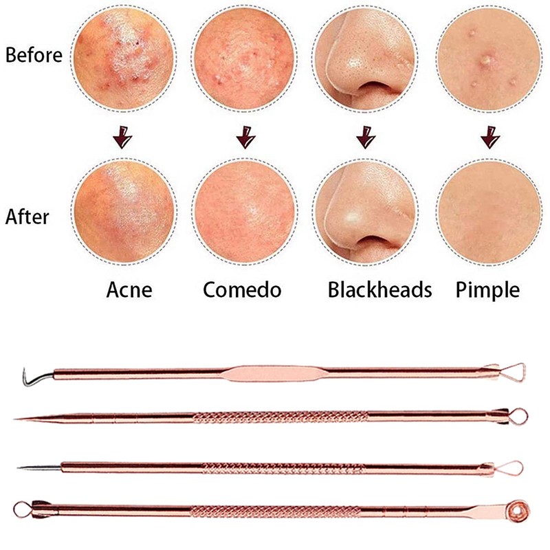 Blackhead Remover Tool Kit,4 Pieces Comedone Extractor Tool Blemish Whitehead
