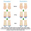 Endoto Supination and Pronation Correction Insoles for Men Women Kids