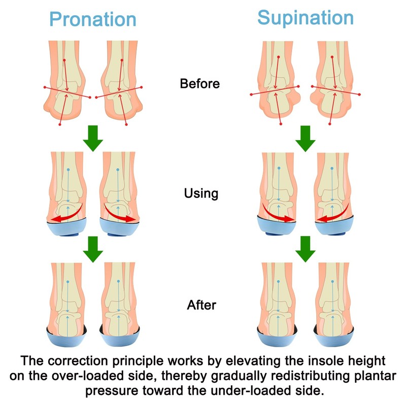 Endoto Supination and Pronation Correction Insoles for Men Women Kids