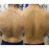 Crema Despigmentante Quita Manchas Acné Paño Vitíligo De 30g