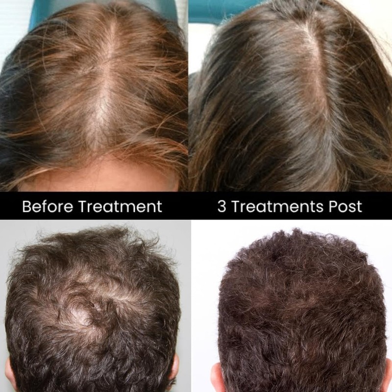 Scalp Exosomes with Growth Factor Peptides (EGF & IGF), GHK-Cu,