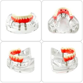 All-On-4 - Modelo de implantes dentales de mandíbula inferior, modelos de dientes de puente Malone, modelo de dientes de sobredentadura dental con implantes de reacondicionamiento