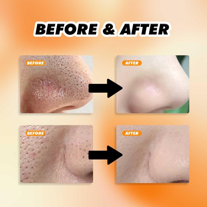 Charcoal Nose Patch, Blackhead Removal Strips, 10 Pack, Deep Cleansing