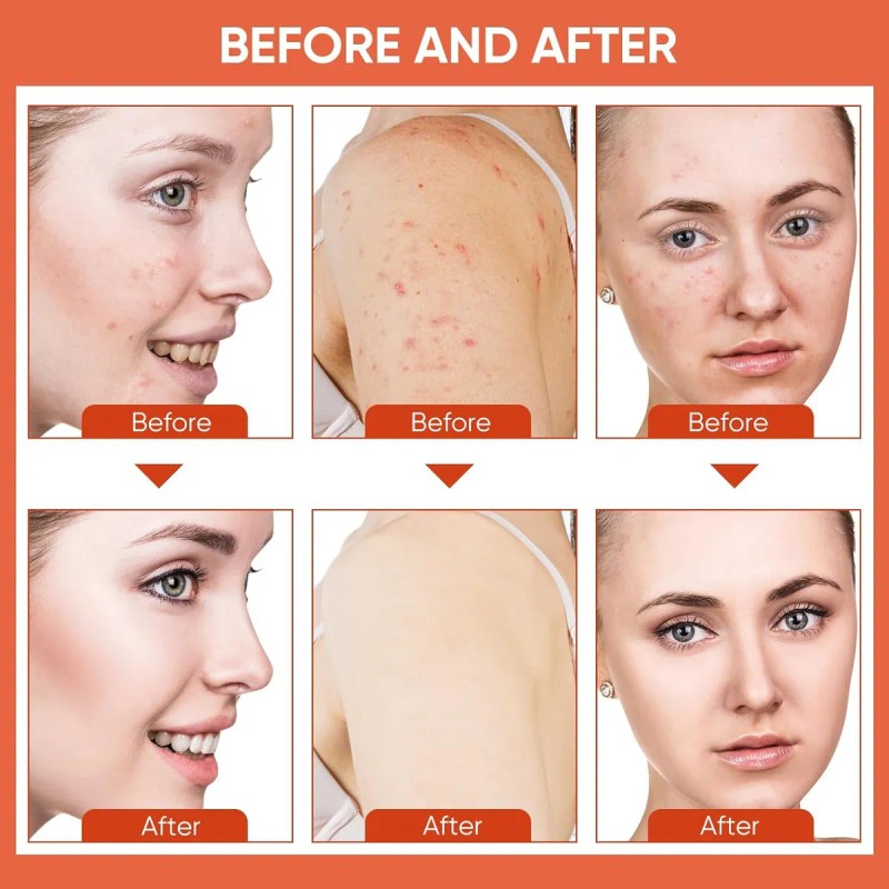 Crema Facial De Acné, Tratamiento Con Acné Quístico De Ácido