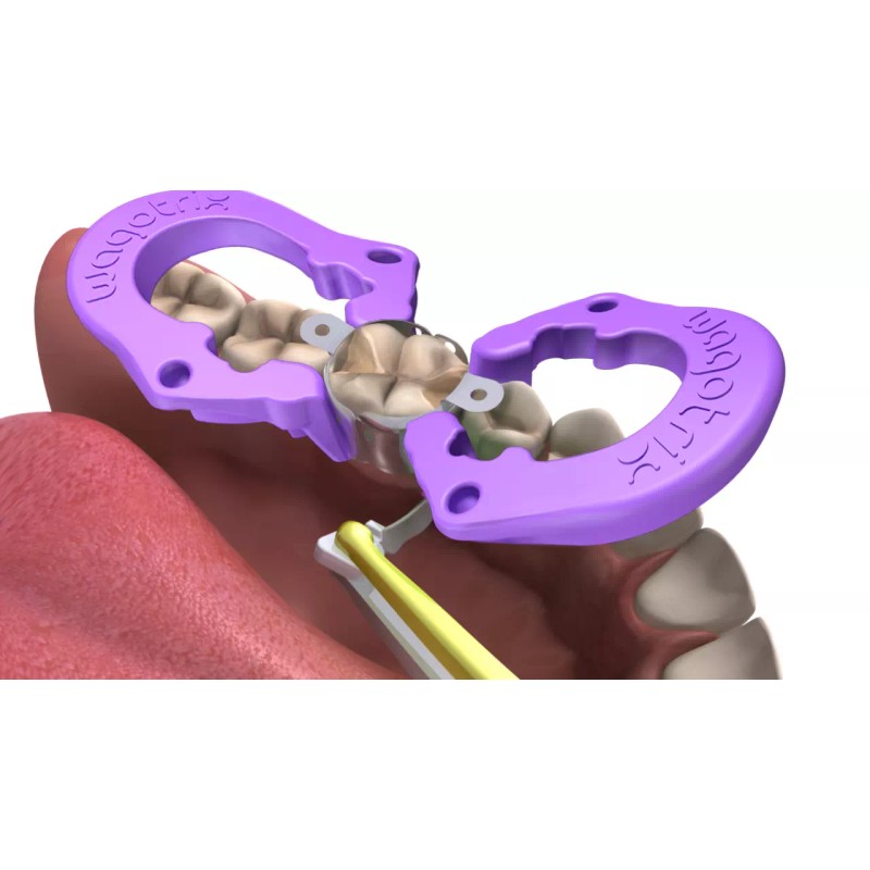 Wagotrix Universal Single-Use Matrix Rings - 100 Pack