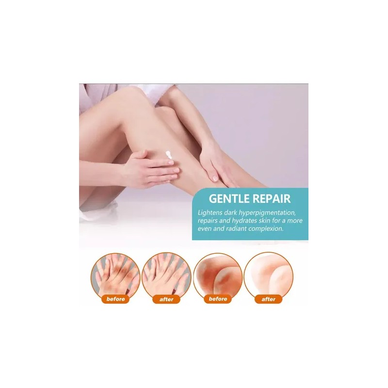Crema Para Acantosis Nigricans , 3 Piezas