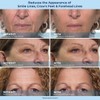 Plexa derm Rapid Reduction Wrinkle Serum - Reduces Under-Eye Bags,