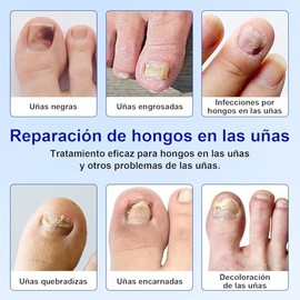 63 Pieces Parches De Cuidado Para Las UñAs,Parche Corrector De UñAs De Los Pies,Treatment Nail Support Nail Care,Reparadores Intensos - Mejora el Colo