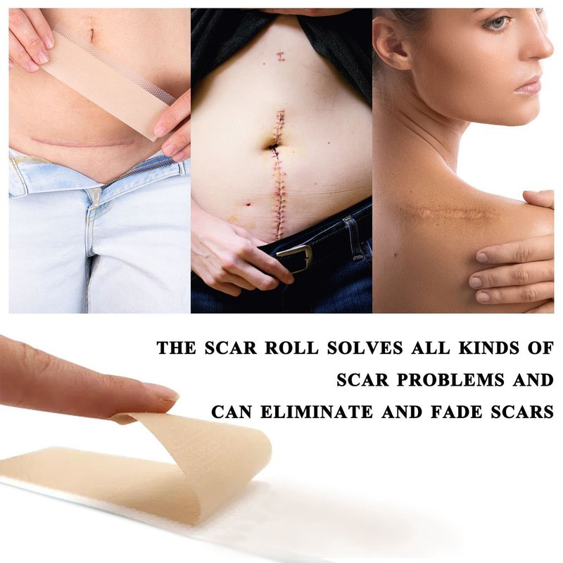 4.9ft 1.6in Scar Roll Silicone Scar Sheets Professional Scar Removal