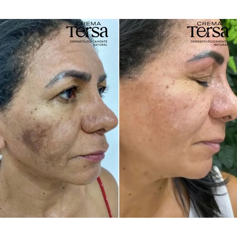 Crema Tersa Despigmentante Quita Manchas Acné Paño De 50g
