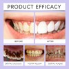 Professional LED Teeth Whitening Kit, Home Treatment System with Remineralization