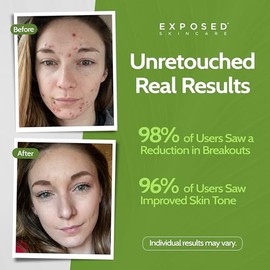 Clear Pore Serum by Exposed Skin Care, eliminate White-Heads and Black-Heads; Salicylic Acid 1%, 1.7 ounces