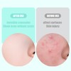 LQIOACU 360 Stück Pickel Patch, Hydrokolloid Acne Pimple Patches, Anti