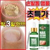 [국내배송] 발톱 앰플 문제성 발톱 곰팡이 한번에끝내는 손발톱 영양제 MOYALIE