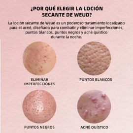 2pzs Weud Loción Antiacné Seca Barros Y Espinillas 29ml