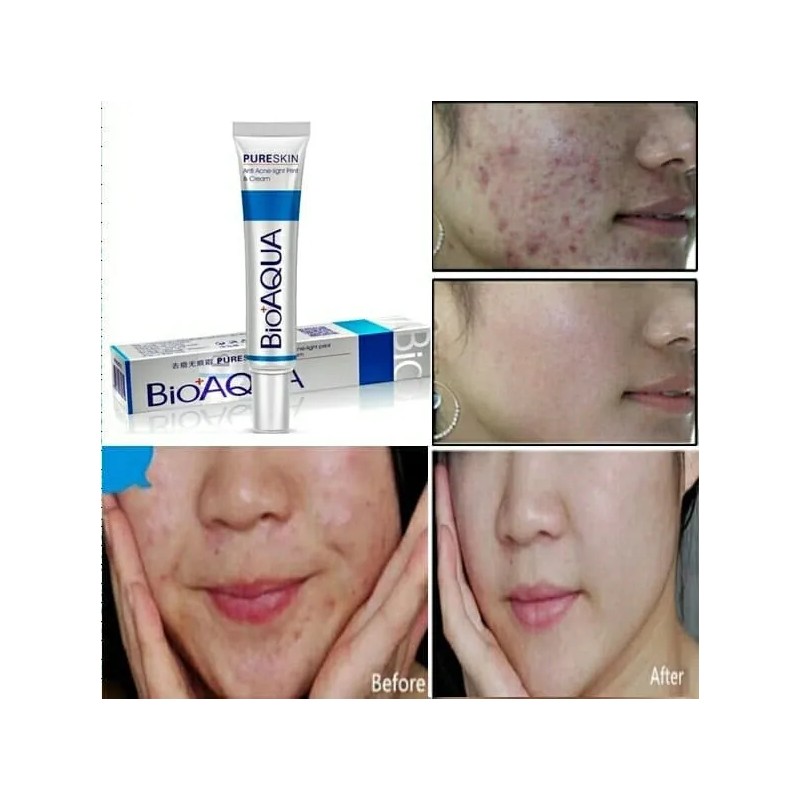 Crema Anti Acné Barros Granos Hidrata Puntos Negros Aclara Indistinto