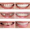 2 Pairs, Top and Bottom,Adjustable for Men and Women,Beautiful Smile(White)
