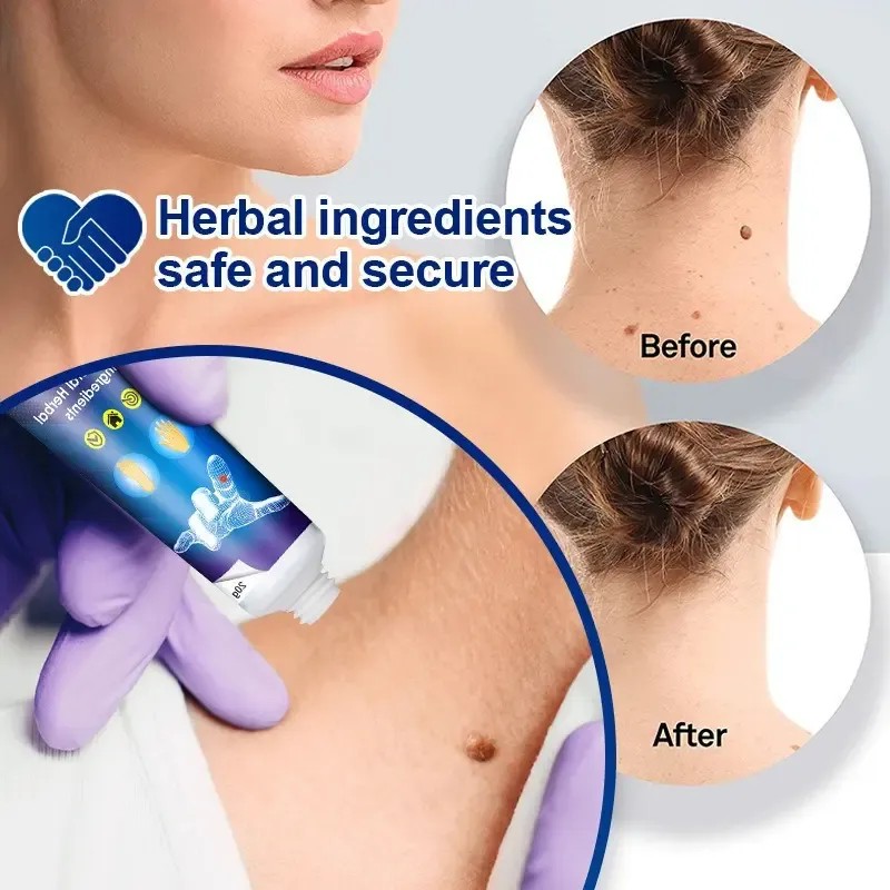 Crema Removedora De Verrugas Rápida Y Fácil, Pomada, 20 G