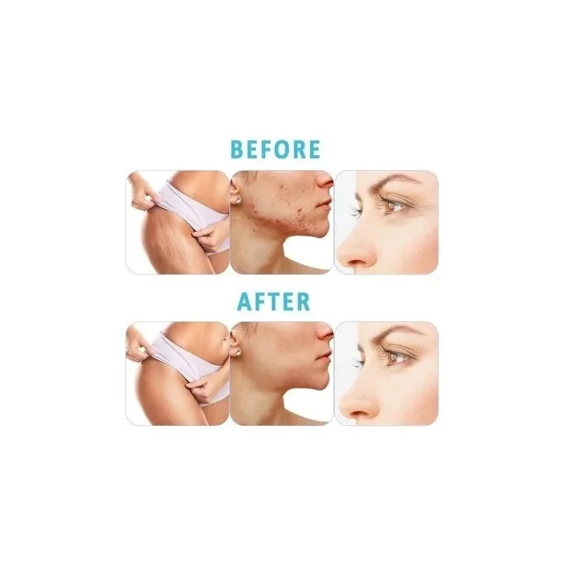 Derma Roller 0.5 Mm Facial Dermaroller Barba
