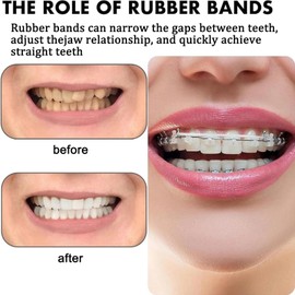 Small Orthodontic Elastic Bands - 5PCS/Pack, for Teeth Braces, Dental, Stretchable Brace Rubber Bands, Teeth Alignment Accessories
